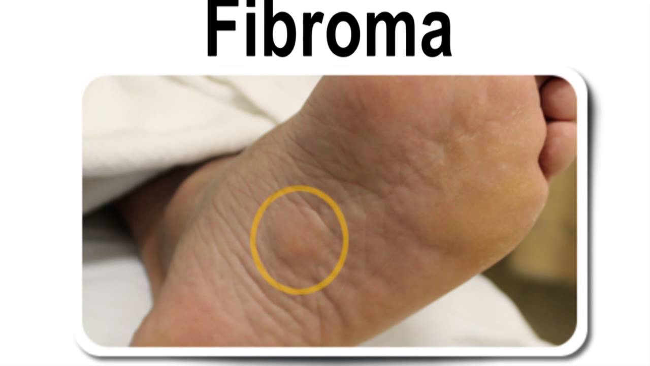 Natural Treatment For Fibromatosis Natural Treatment For Fibromatosis