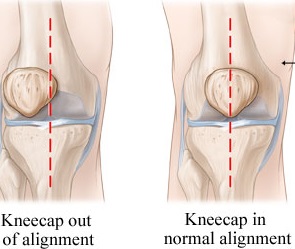 pivotal motion physiotherapy patellofemoral pain syndrome patella femoral syndrome
